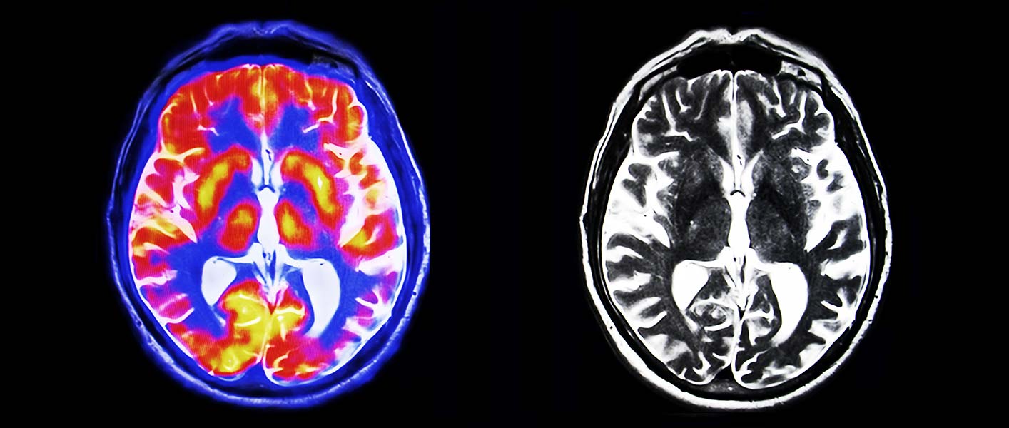 Kognitive Störung – Demenz – Dr. med. Andrej Pauls